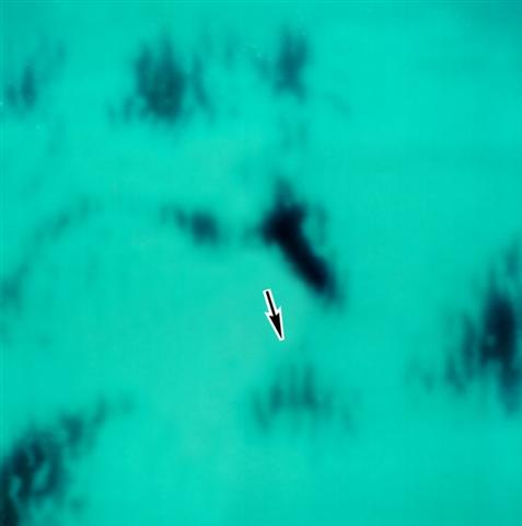 Ультрасонограмма тазобедренного сустава с 4 типом строения