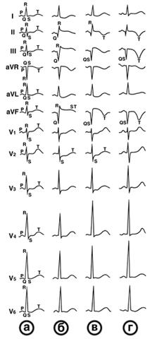Динамика ЭКГ при транмуральном инфаркте миокарда заднедиафрагмальной (нижней) стенки