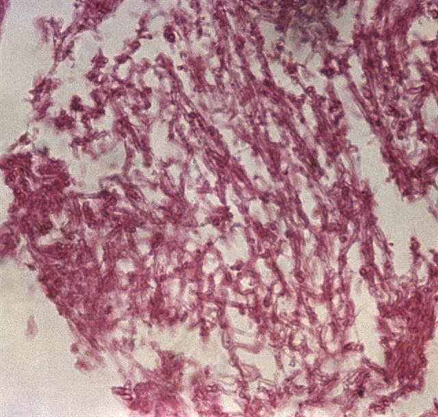 Микропрепарат ткани легкого при аспергиллезе