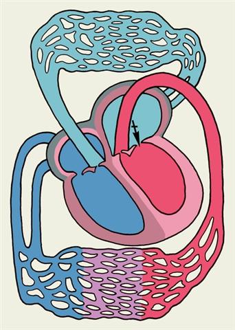 Схема основных изменений сердца и гемодинамики при митральном стенозе