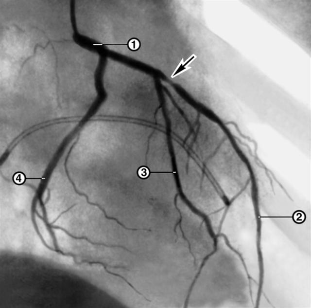 Ангиограмма ствола и ветвей левой коронарной артерии больного со стенокардией напряжения: до лечения
