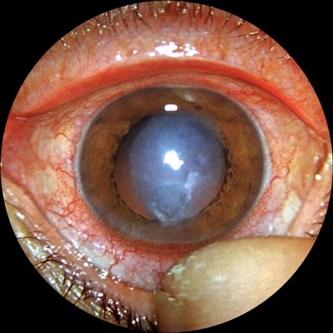 Вид глаза при дисковидном кератите