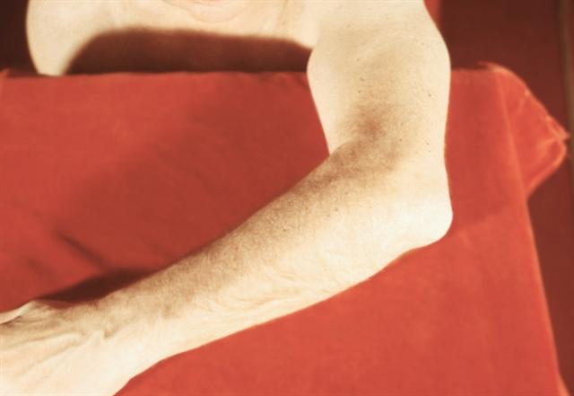 Воспаление синовиальной сумки в области левого локтевого отростка (бурсит)