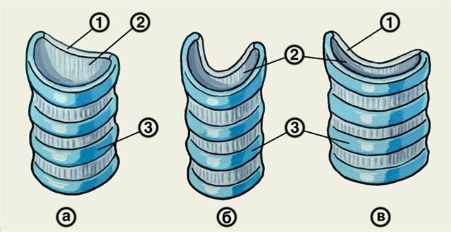 Схематическое изображение изменений просвета трахеи при ее экспираторном стенозе