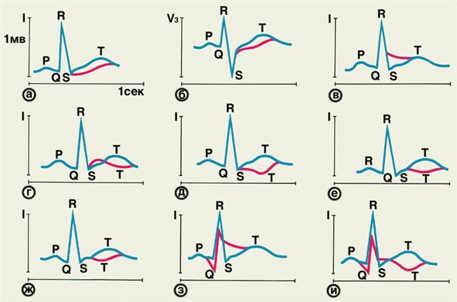 Схематическое изображение изменений ЭКГ при стенокардии, очаговой дистрофии и инфаркте миокарда разной локализации
