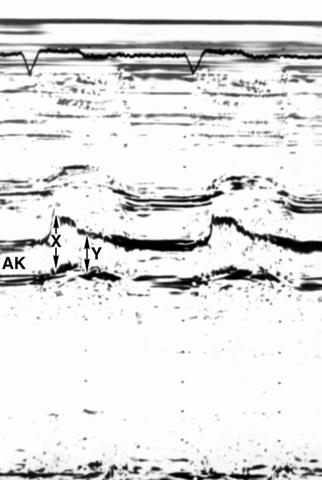 Одномерная эхокардиограмма больного дилатационной кардиомиопатией