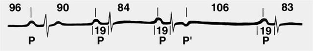 ЭКГ при предсердной форме реципрокного ритма
