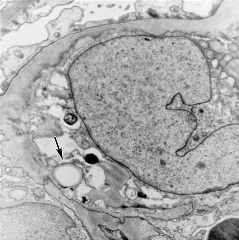 Электронограмма почки при фокальном сегментарном гломерулярном гиалинозе
