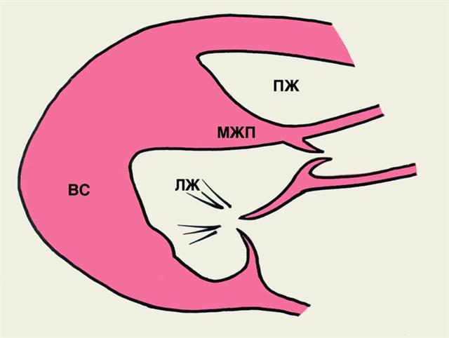 Поясняющая схема к двухмерной эхокардиограмме при верхушечной кардиомиопатии