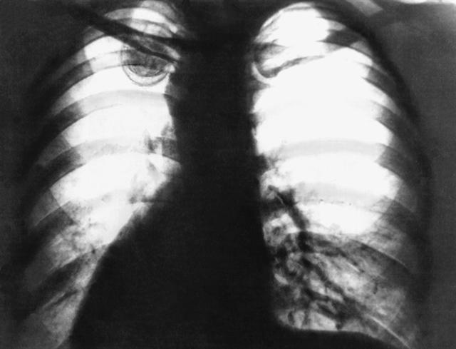Рентгенограмма грудной клетки при аспергилломе левого легкого