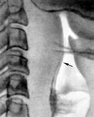 Рентгенограмма шеи при заглоточном абцессе