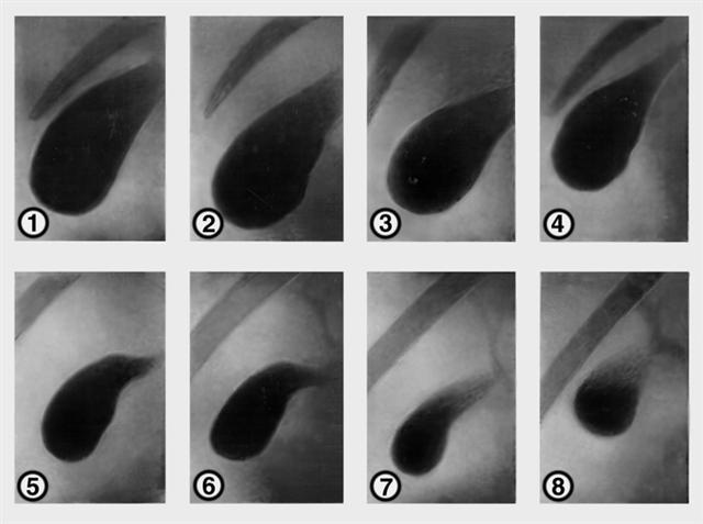 Серия холецистограмм в норме до и после приема желчегонного завтрака