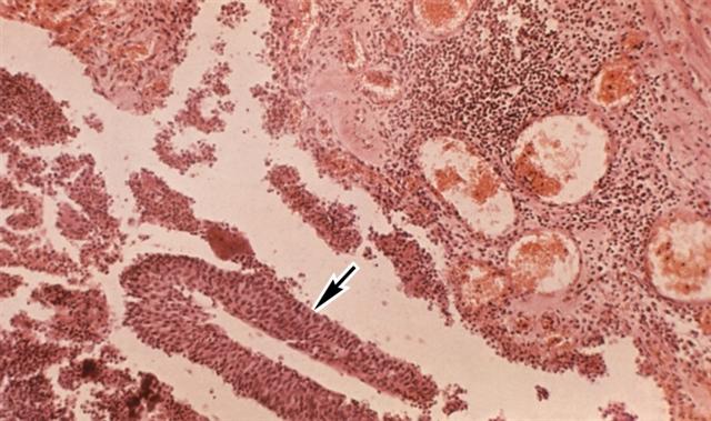 Микропрепарат почки при гнойном пиелонефрите