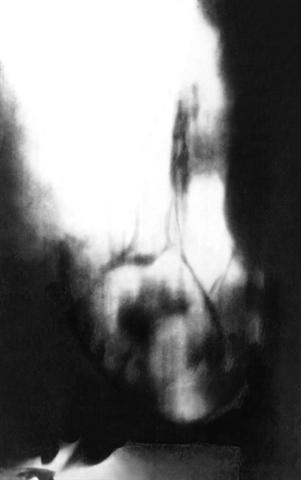 Томограмма левого легкого при аспергилломе