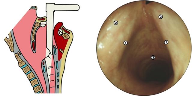 Схематическое изображение этапов введения ларингоскопа