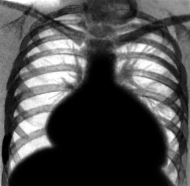 Рентгенограмма грудной клетки больного с дилатационной кардиомиопатией