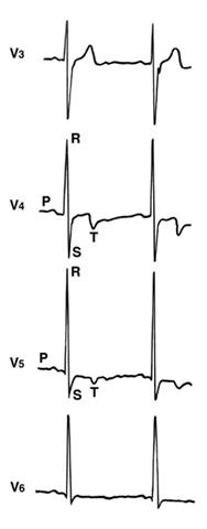 Электрокардиограммы больного ишемической болезнью сердца на фоне гипертонической болезни