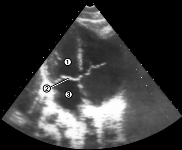Эхокардиограмма в норме