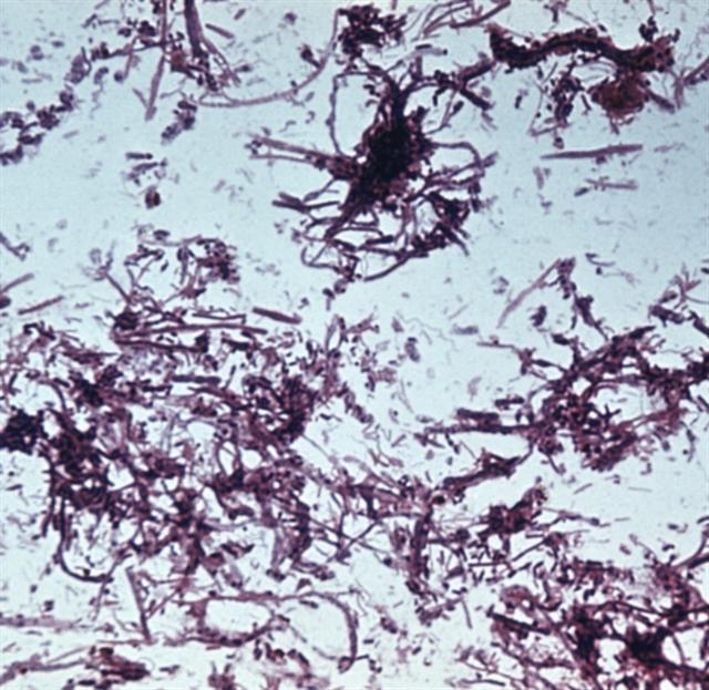 Сапрофитические спирохеты (Spirocheta buccalis) в мазке из зубного налета