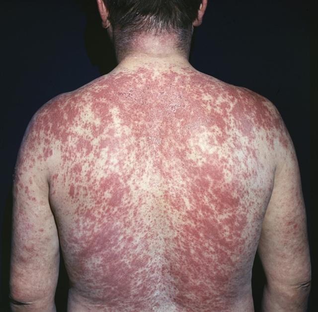 Злоупотребление лекарствами. Острый аллергический дерматит, вызванный бисептолом