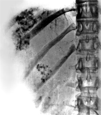 Обзорная рентгенограмма области печени при альвеолярном эхинококкозе