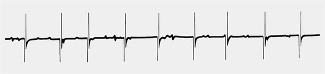 Электромиограмма при поражении передних рогов спинного мозга
