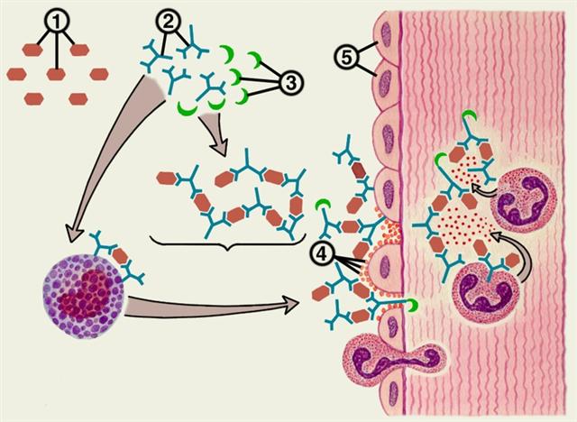 Общий механизм развития аллергической реакции иммунокомплексного типа