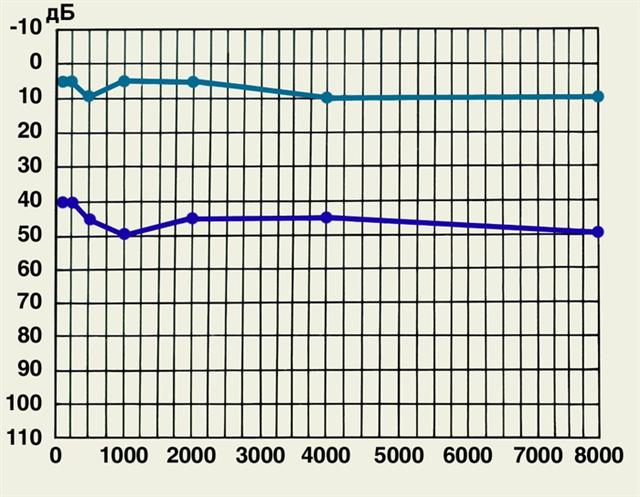 Нарушение Слуха Кондуктивного Характера