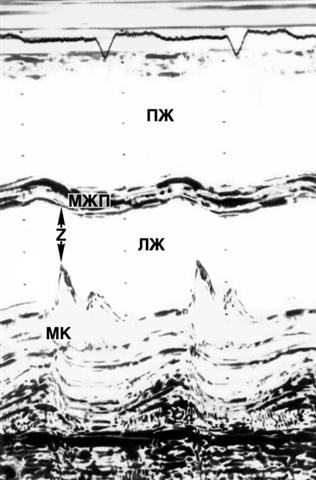 Одномерная эхокардиограмма больного дилатационной кардиомиопатией