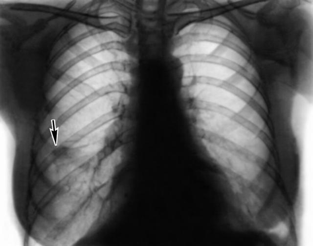 Рентгенограмма грудной клетки больного с эозинофильными летучими инфильтратами