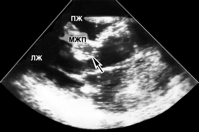 Двухмерная эхокардиограмма больного с обструктивной гипертрофической кардиомиопатией