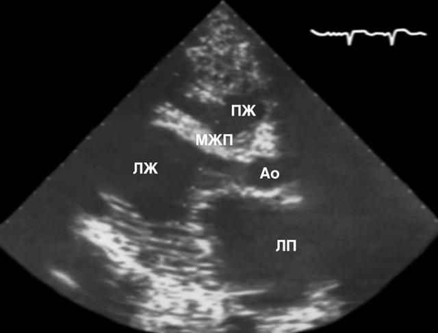 Двухмерная эхокардиограмма больного дилатационной кардиомиопатией