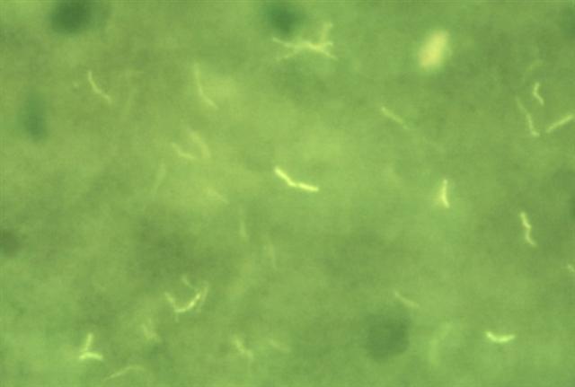 Микобактерии туберкулеза в препарате мокроты