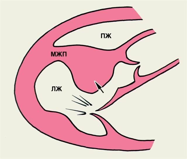 Поясняющая схема к двухмерной эхокардиограмме больного с обструктивной гипертрофической кардиомиопатией