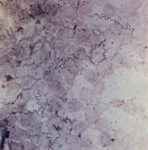 Многочисленные спирохеты (Borrella persica) в мазке из крови больного клещевым возвратным тифом