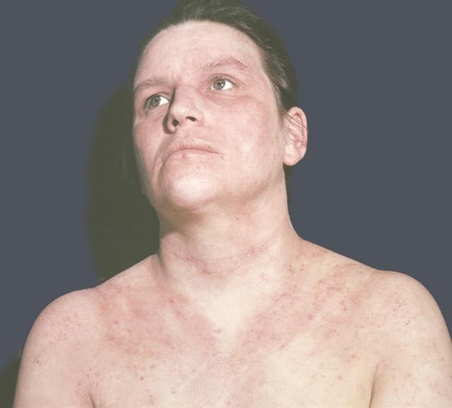 Диффузный нейродермит