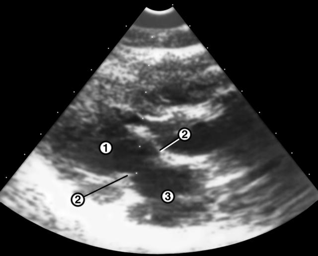Эхокардиограмма при рестриктивной кардиомиопатии