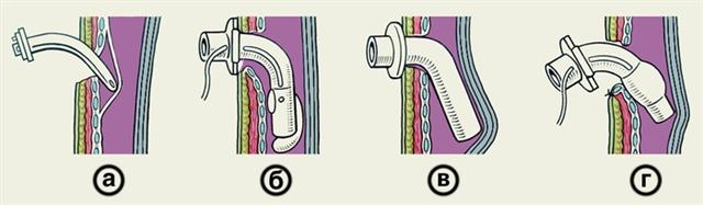 Схематическое изображение некоторых осложнений трахеостомии