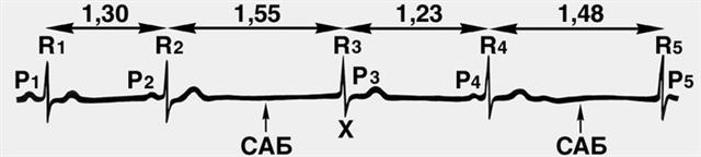Выскакивающее узловое сокращение на фоне синоаурикулярнои блокады