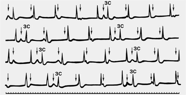 ЭКГ при неполной атриовентрикулярной диссоциации типа интерференции с диссоциацией
