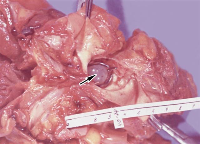 Макропрепарат сердца при остром инфекционном эндокардите после протезирования аортального клапана сердца