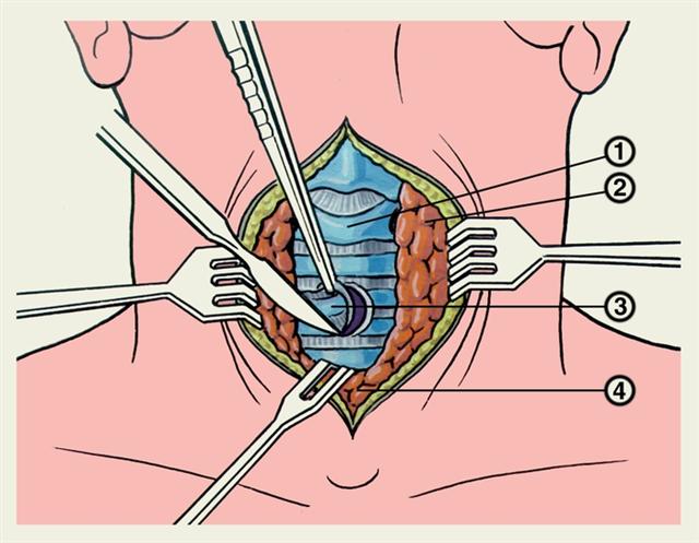 Схематическое изображение формирования трахеостомического отверстия
