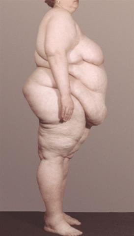 Больная гипофизарным ожирением