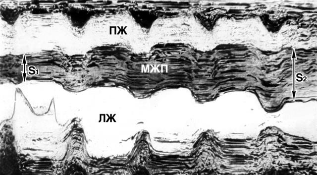 Сканирующая одномерная эхо-кардиограмма при верхушечной кардиомиопатии