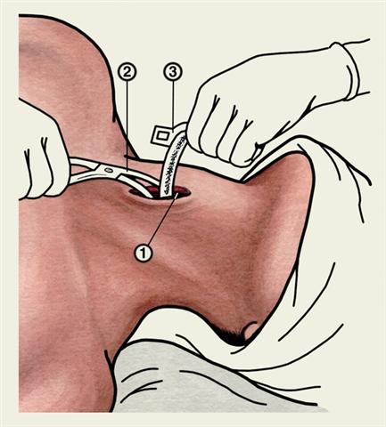 Схема расширения коникостомы и введения в нее трахеотомической трубки