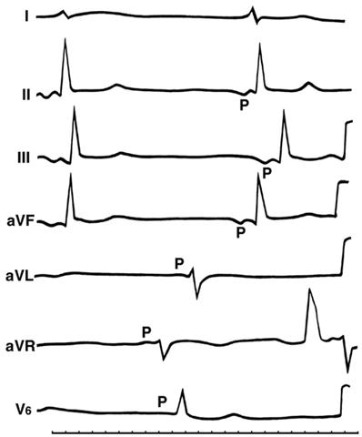 ЭКГ при ритме коронарного синуса