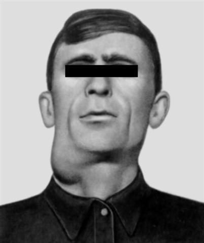 Больной ангинозно-бубонной формой туляремии