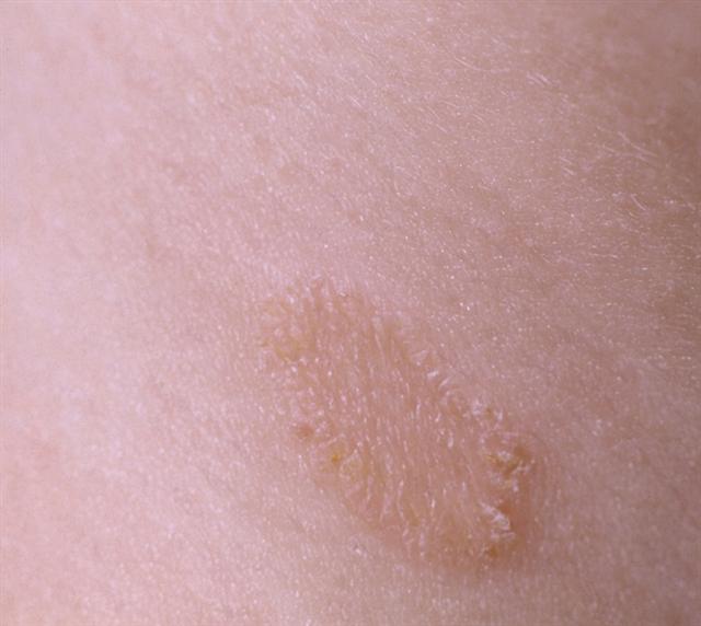 Очаг микроспории на гладкой коже