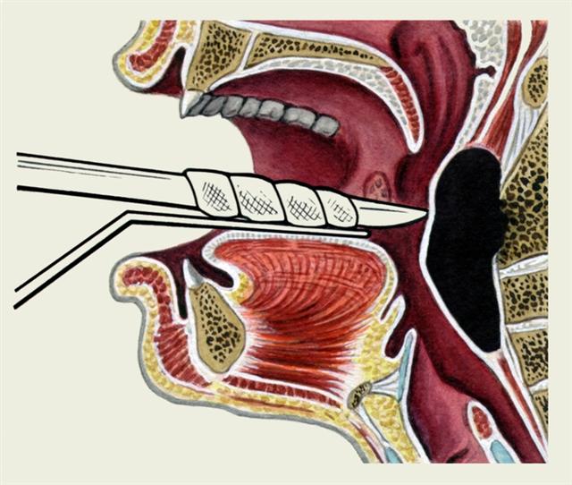 Схематическое изображение вскрытия заглоточного абсцесса